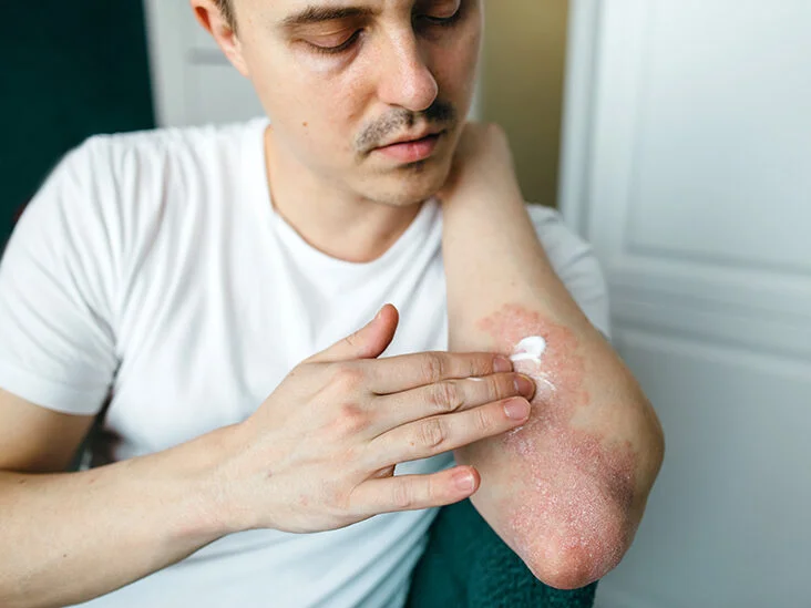 Some Effective ways to Cure Eczema And Psoriasis Permanently.