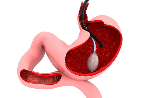 Intragastric Balloon surgery Dubai