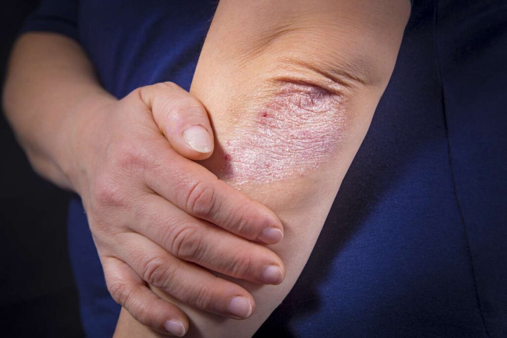 psoriasis symptoms causes and treatment