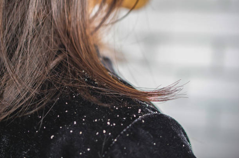 Dandruff: Understanding the Causes, Symptoms, and Treatments