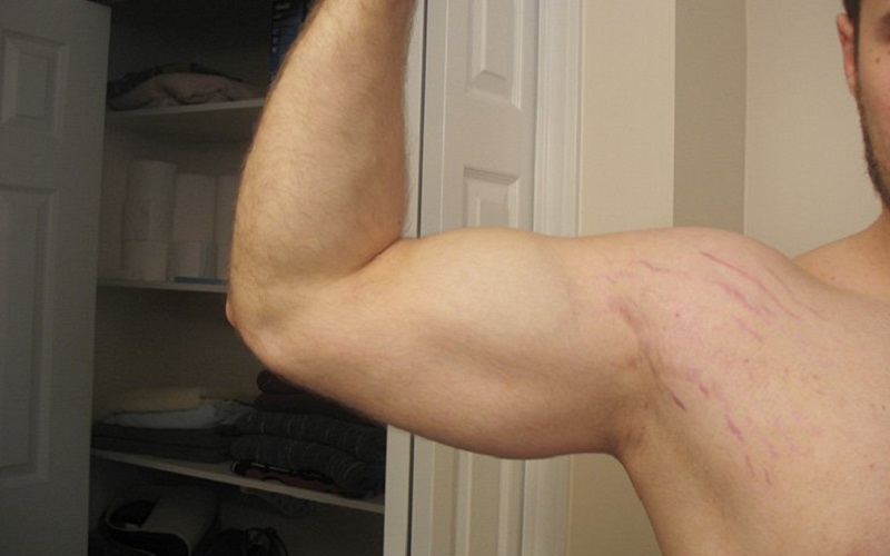 Stretch Marks