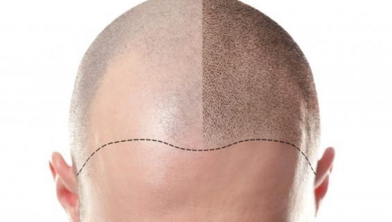 Choosing the Right Hair Transplant Specialists for Natural-Looking Hairlines
