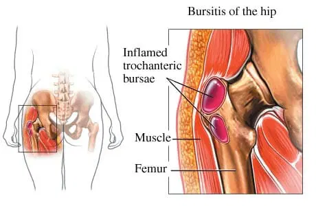 hip bursitis exercises to avoid