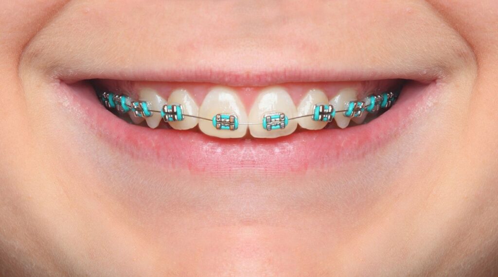 braces cost miami