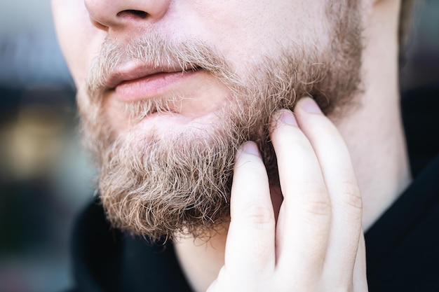 beard transplant