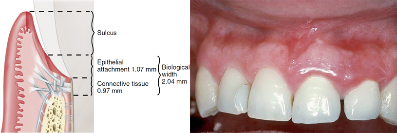 dental biologic width
